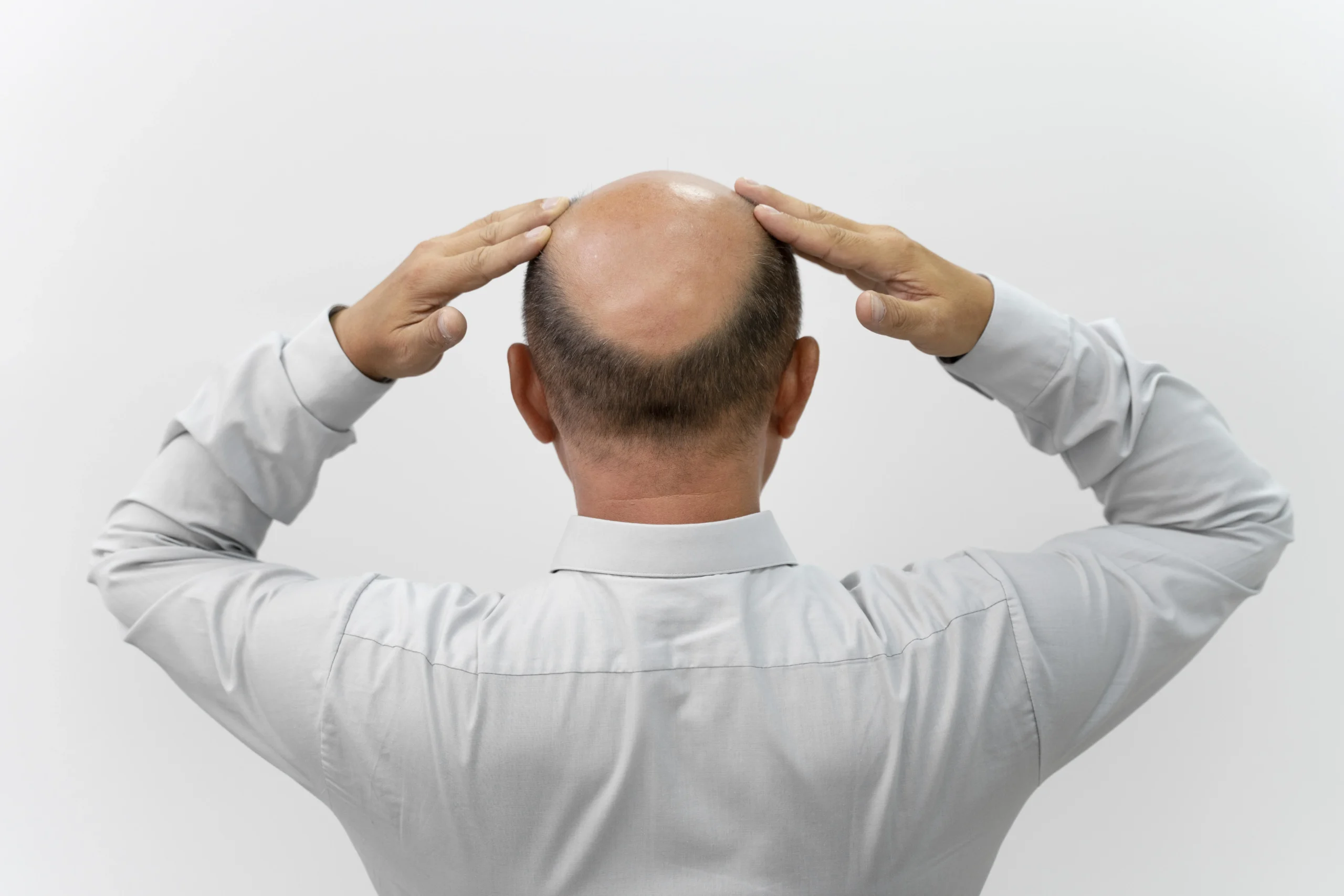 Can Stage 7 Baldness Be Treated With a Hair Transplant?