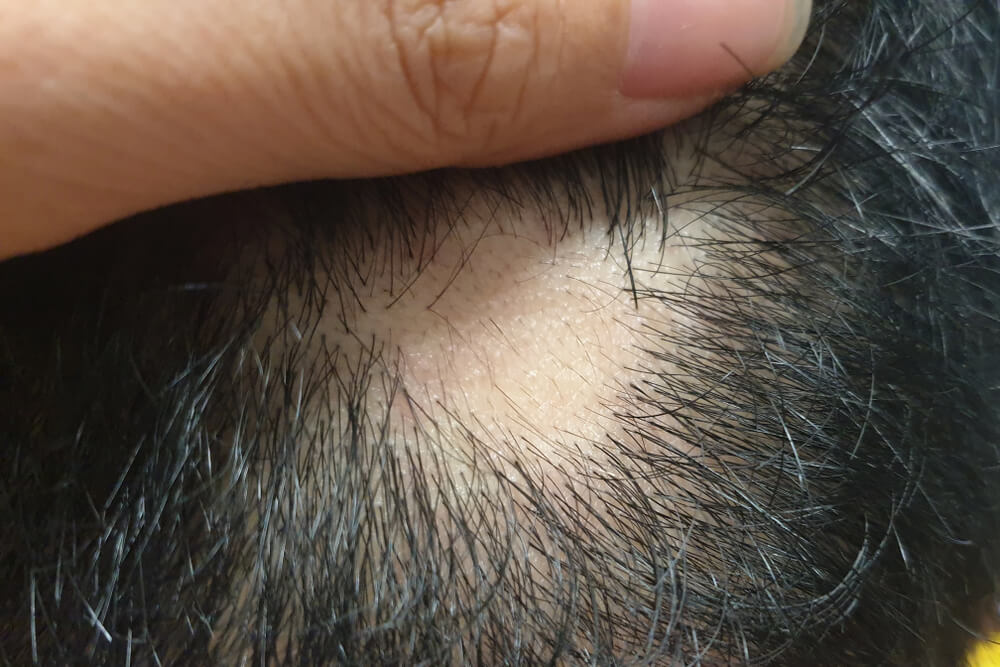 Alopecia Areata treatment in thane