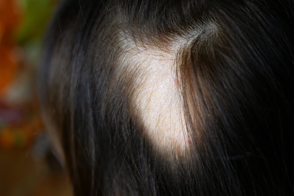 Alopecia Areata treatment in thane