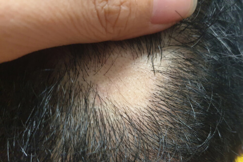 alopecia areata treatment