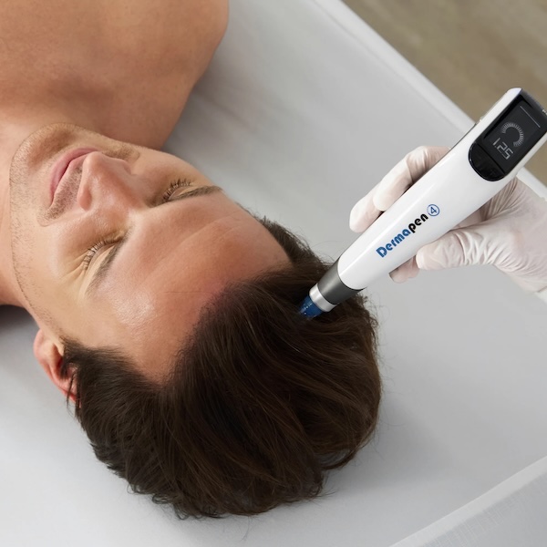 dermapen 4 scalp microneedling hair loss thane