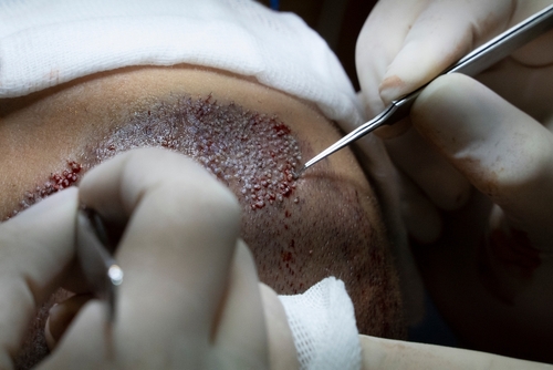 fue hair transplant in thane