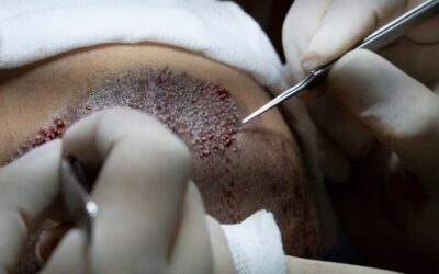 Hair Transplant Cost in Thane: A Complete Pricing Guide