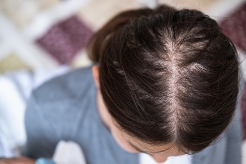 Female hair fall treatment in thane