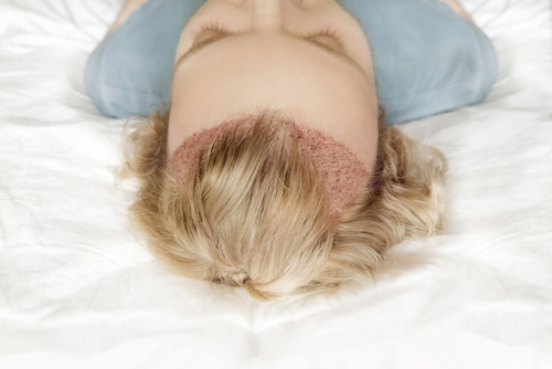 hair transplant for women in thane
