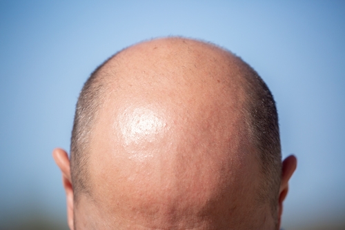 male hair transplant in thane